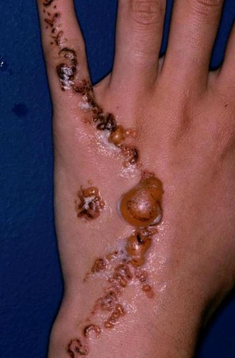 Tatouage au henné : gare aux allergies !
